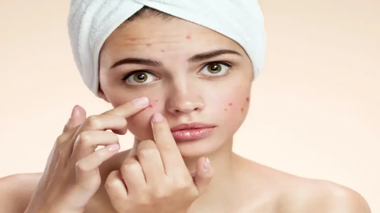 10 Kebiasaan Harian yang Dapat Membantu Mengatasi Acne