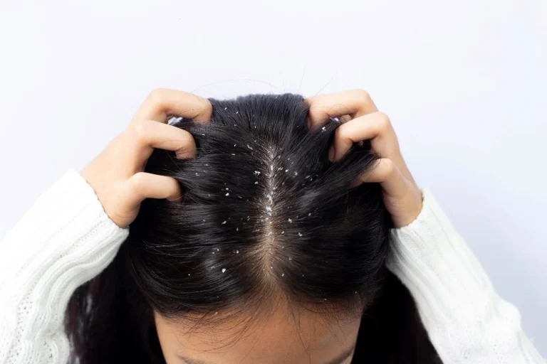 7 Tips Perawatan Rambut untuk Mengatasi Ketombe Membandel
