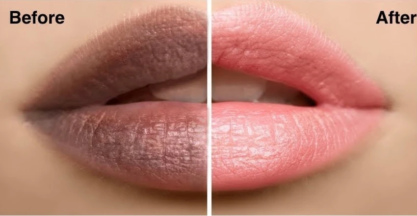 10 Cara Mengatasi Bibir Hitam Secara Alami dan Aman
