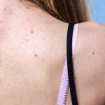 10 Cara Mengatasi Jerawat Punggung Secara Efektif