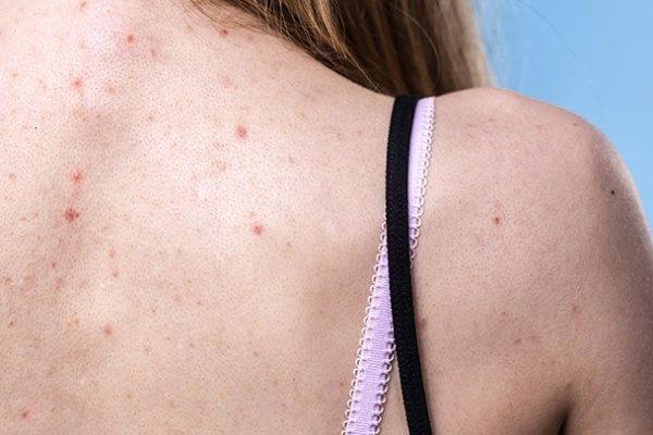 10 Cara Mengatasi Jerawat Punggung Secara Efektif