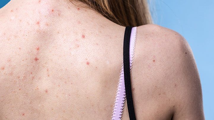 10 Cara Mengatasi Jerawat Punggung Secara Efektif