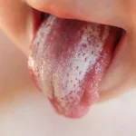 6 Tips Mencegah Infeksi Jamur di Lidah
