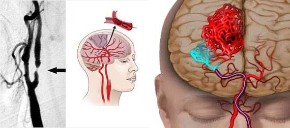 5 Cara Pemulihan Dini Setelah Serangan Stroke 5 Cara Pemulihan Dini Setelah Serangan Stroke