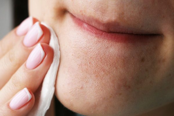 7 Cara Mencegah Komedo Membandel di Dagu